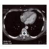 TAC y RMC en el diagnóstico de cardiopatía isquémica