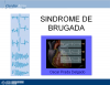 Síndrome de Brugada