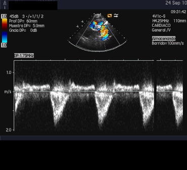 doppler_Ao_descendente_Reverso_diastolico_3